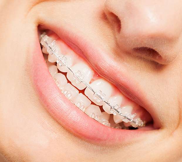 Missouri City Clear Braces