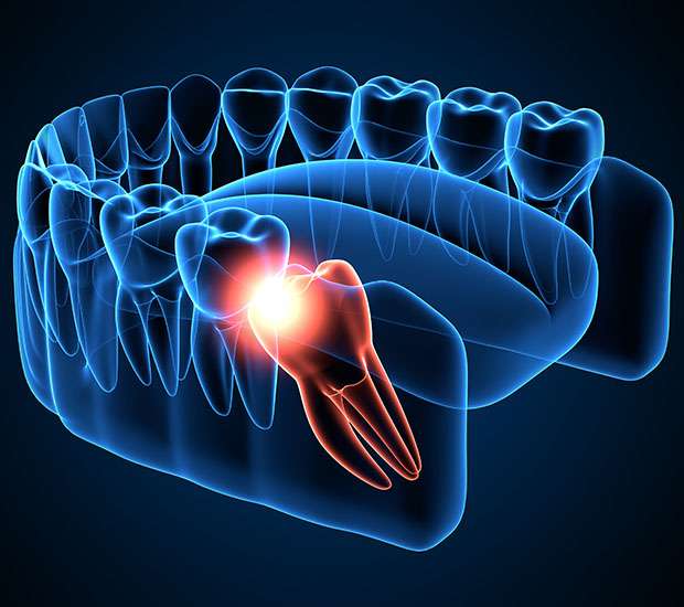 Missouri City Wisdom Teeth Extraction
